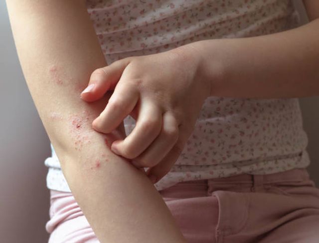 Principles for Dealing with Allergies in Youth Organizations